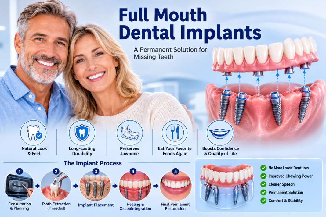 Full Mouth Dental Implants