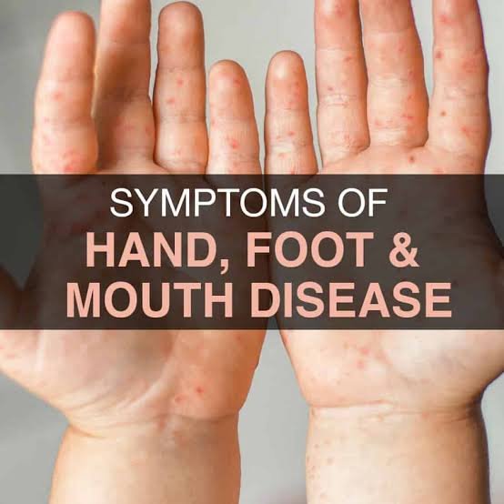 Hand Foot and Mouth Disease in Adults